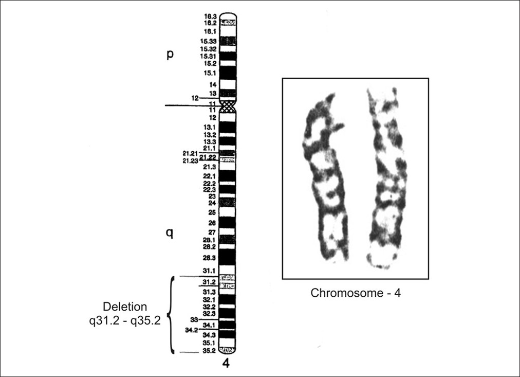 Terminal 4q deletion syndrome Kuldeep C M, Khare A K, Garg A, Mittal A,  Gupta L - Indian J Dermatol