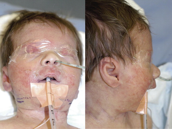 References in Mandibular distraction in the setting of chromosome 4q  deletion - Journal of Plastic, Reconstructive & Aesthetic Surgery