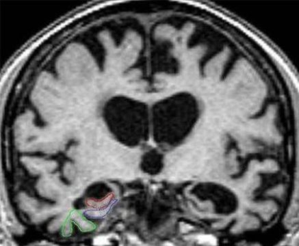 Description: Image result for mri alzheimer's disease