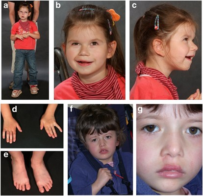 A novel microdeletion syndrome involving 5q14.3-q15: clinical and molecular cytogenetic characterization of three patients | European Journal of Human Genetics
