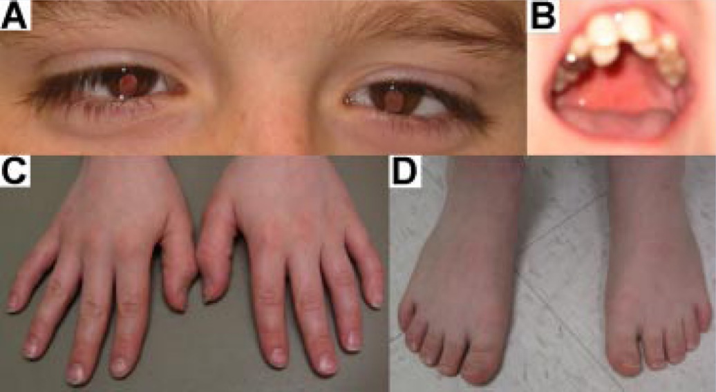 Interstitial deletion 5q14.3-q21 associated with iris coloboma, hearing loss, dental anomaly, moderate intellectual disability, and attention deficit and hyperactivity disorder. - Abstract - Europe PMC