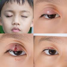 1,045 Stye Pictures, Stye Stock Photos & Images | Depositphotos®